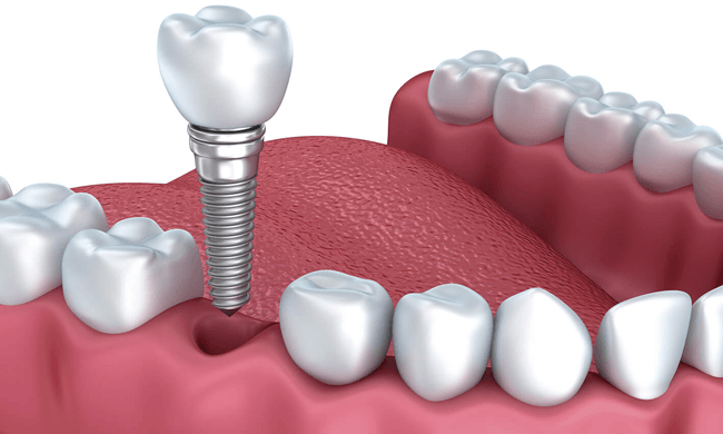 Trồng răng implant 1